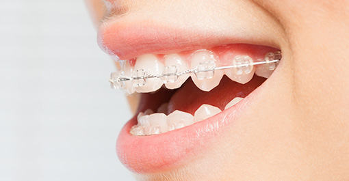 審美ブラケットを使った表側矯正（ホワイト×ホワイト）