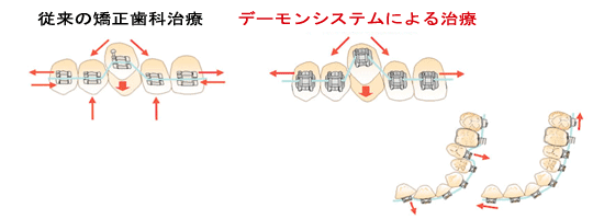 矯正メカニクス（治療方針、矯正装置、矯正用ワイヤー）の考慮、調整