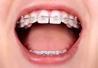 子供の矯正はいつから始めたらいい?