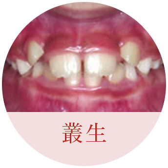 叢生