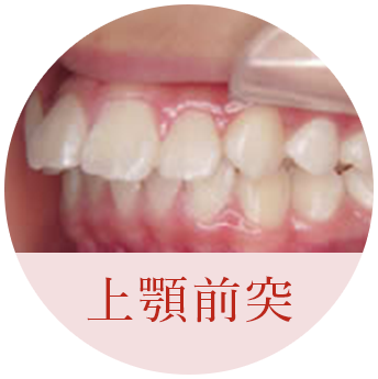 上顎前突