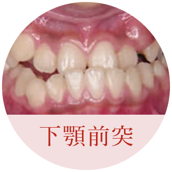 下顎前突