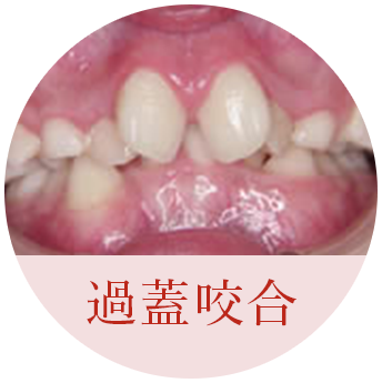 過蓋咬合