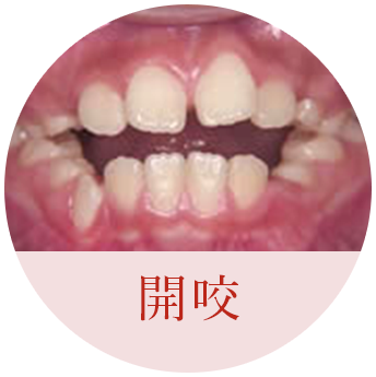 開咬