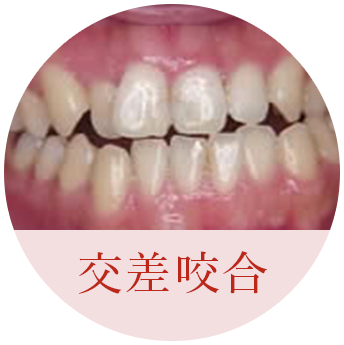 交差咬合
