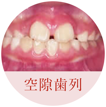 空隙歯列