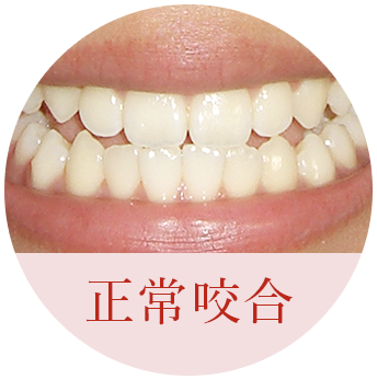 正常咬合